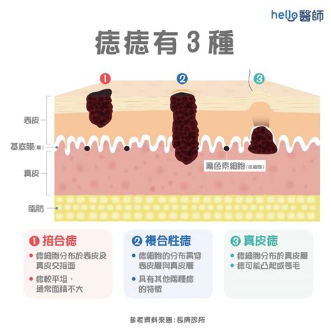 痣長在臉上|痣變大、痣多或長毛會變皮膚癌？認識痣的形成與原因